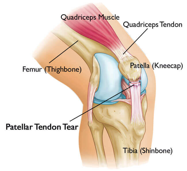 Knee tendinitis